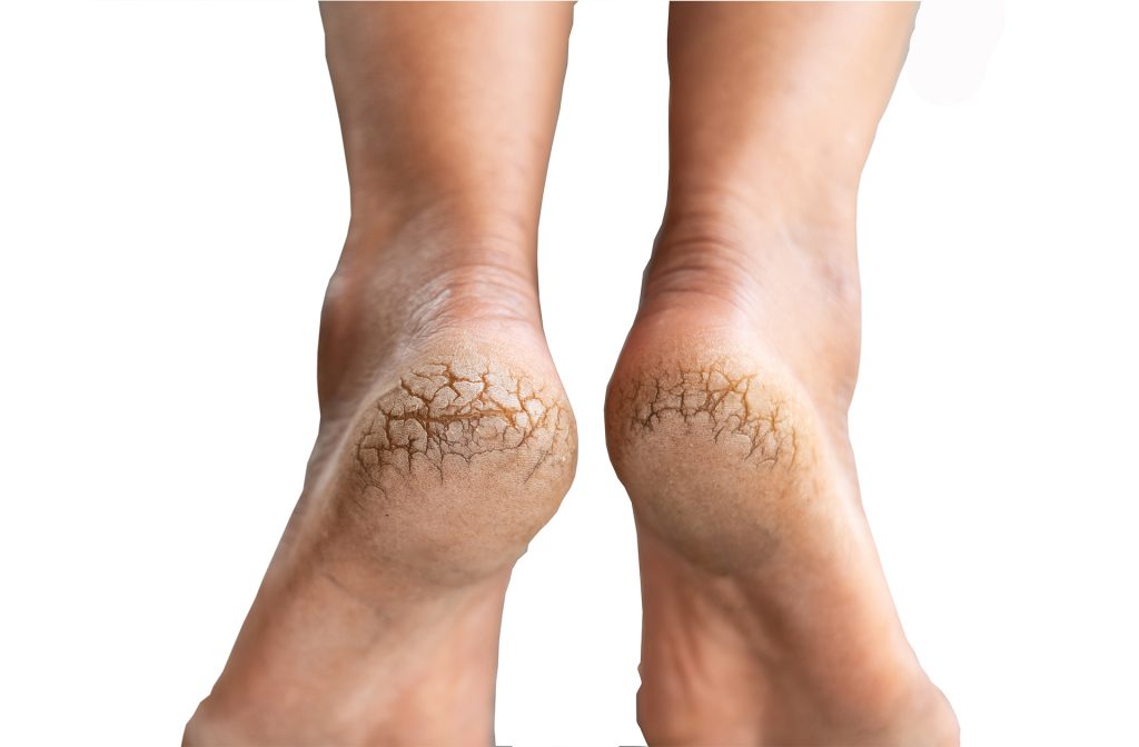 Cracked Heels What Are They & How Do We Treat The Healthcare Hub