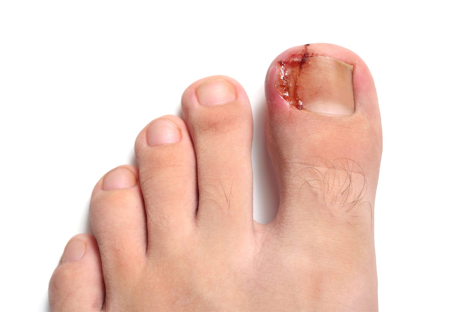 Ingrown Toenail Treatment Expert Advice & Care The Healthcare Hub
