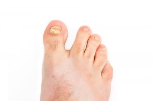 thickend toenail