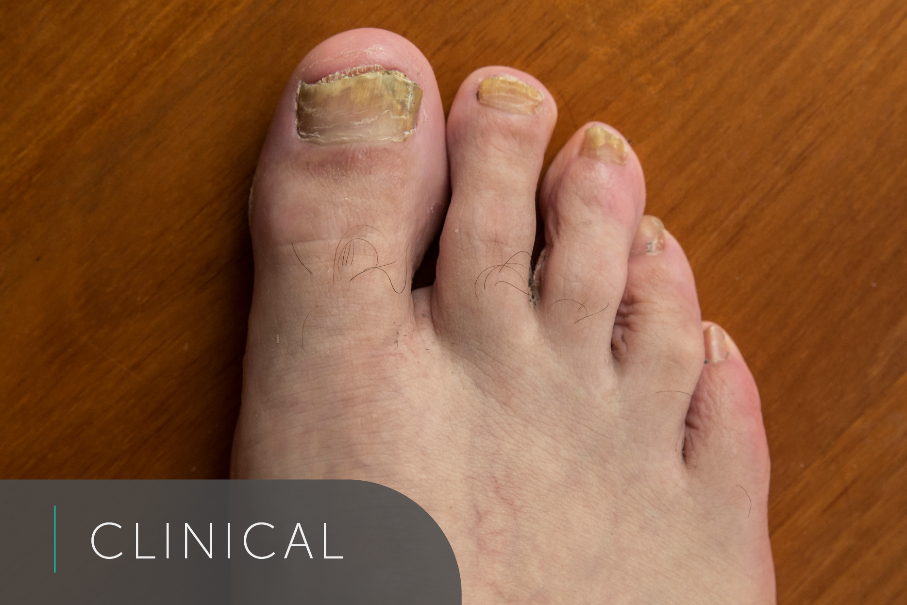 Closeup Of A Foot With Nail Fungus On A Wooden Background Collage Nail  Treatment Before And