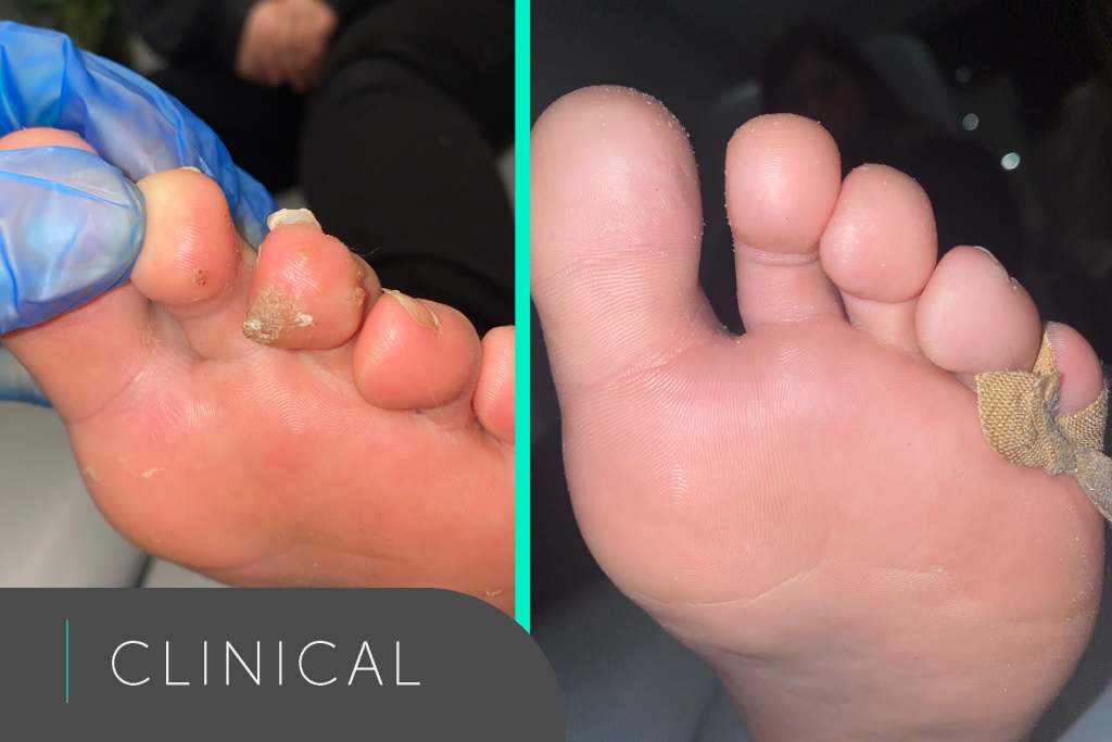 Verruca Treatment With Swift Before & After The Healthcare Hub