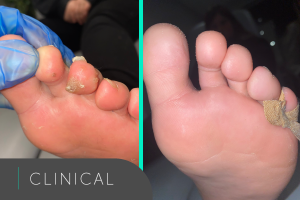 verruca treatment - before and after